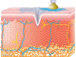 Collagen Synthesis Begins